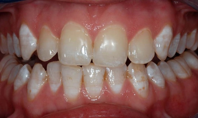 Răng nhiễm fluor gây mất thẩm mỹ