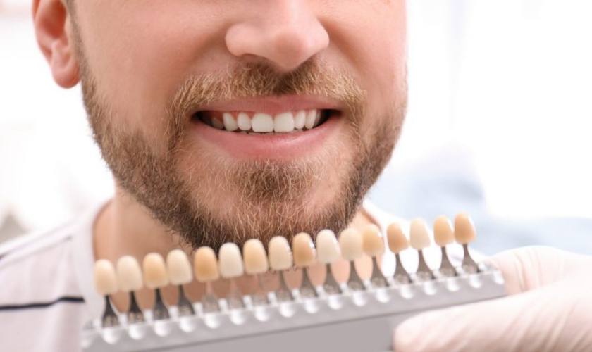 So màu răng sau khi tẩy trắng