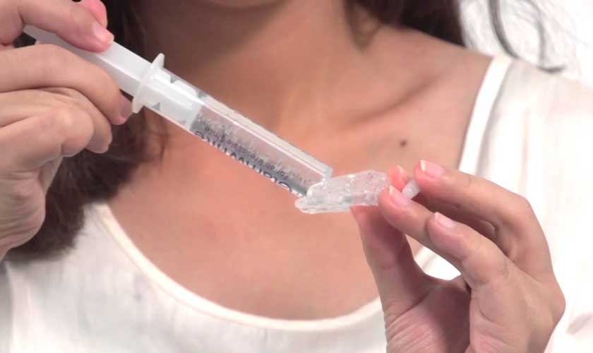 Tẩy trắng răng bằng máng tẩy tại nhà