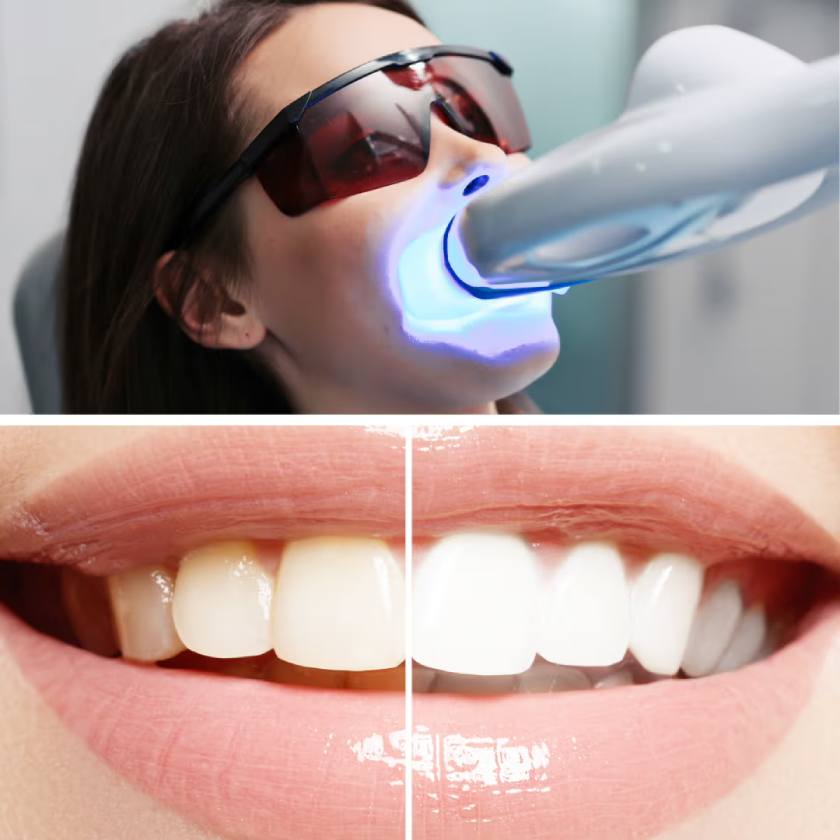 Công nghệ tẩy trắng răng laser là phương pháp làm trắng răng được đánh giá tốt nhất hiện nay