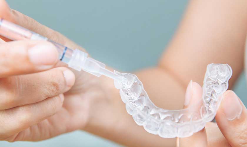 Tẩy trắng răng tại nhà bằng máng tẩy đơn giản, hiệu quả và chi phí thấp