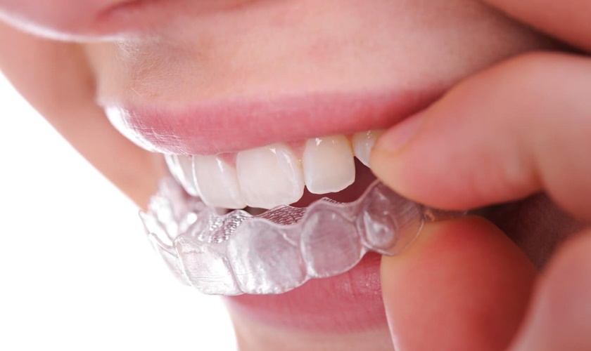 Phương pháp tẩy trắng răng tại nhà