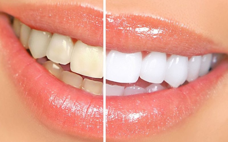 Những phương pháp tẩy trắng răng hiệu quả nhất hiện nay
