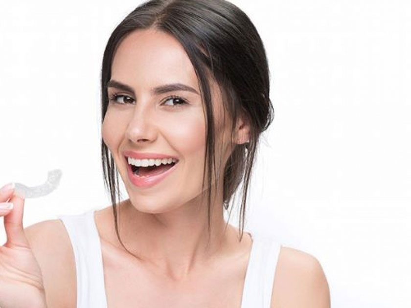 Tẩy trắng răng tại nhà bằng máng