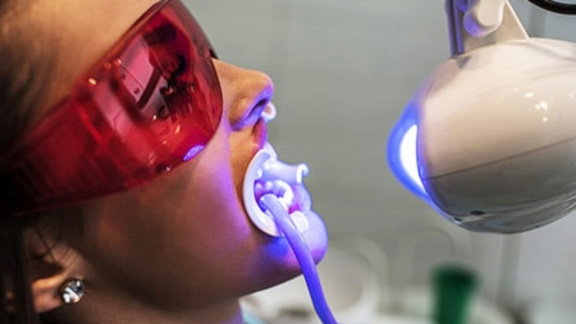 Tẩy trắng răng bằng công nghệ Laser Whitening