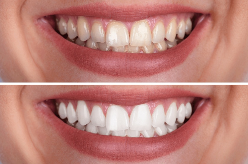 Tẩy trắng răng giúp bạn sở hữu hàm răng trắng sáng tự nhiên