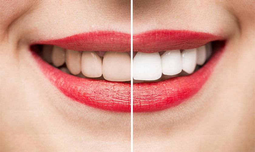 Trước và sau khi tẩy trắng răng
