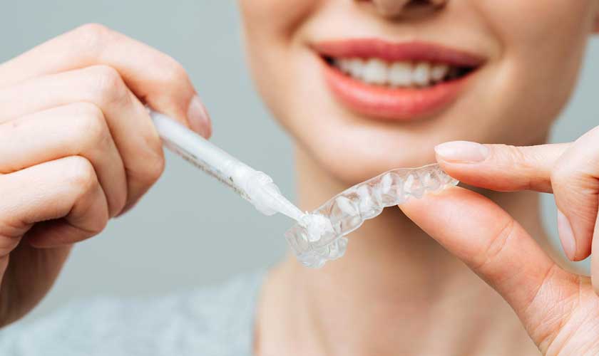 Ngậm máng tẩy trắng răng