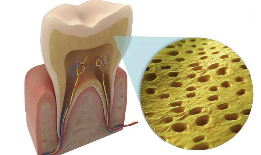 Hoạt chất tẩy trắng răng có thể làm lộ các vi ống ngà và gây ê buốt răng