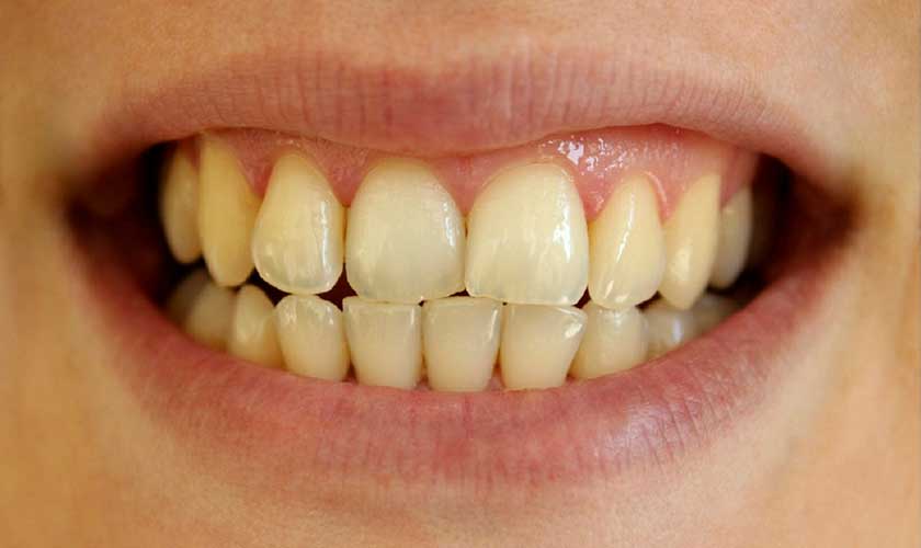 Tiết lộ nguyên nhân khiến răng ố vàng và cách điều trị