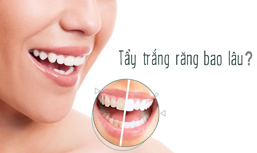 Thời gian thực hiện tẩy trắng răng mất bao lâu?