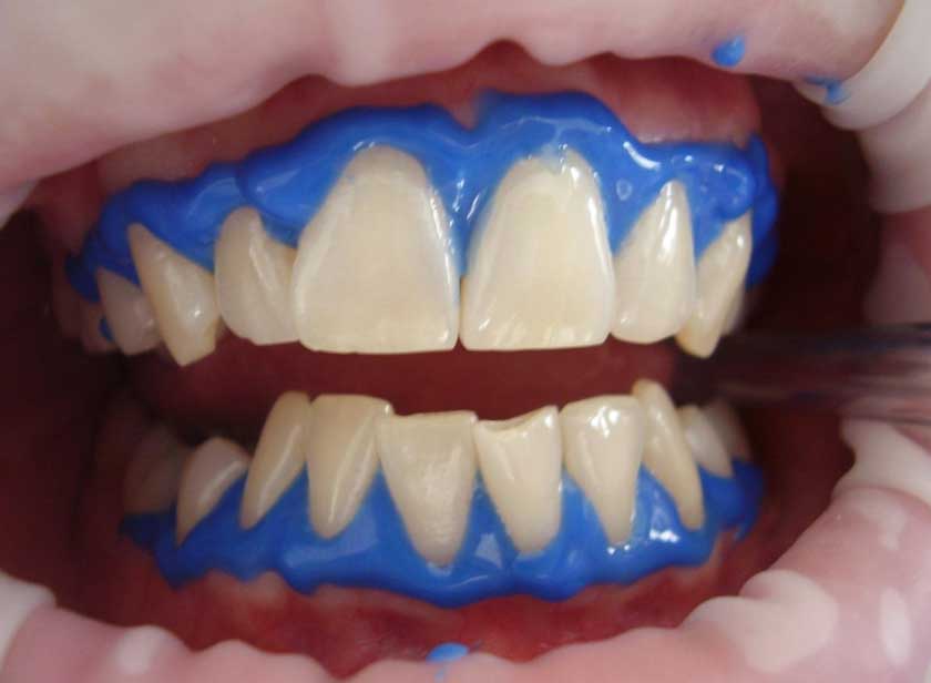 Bôi thuốc tẩy trắng răng