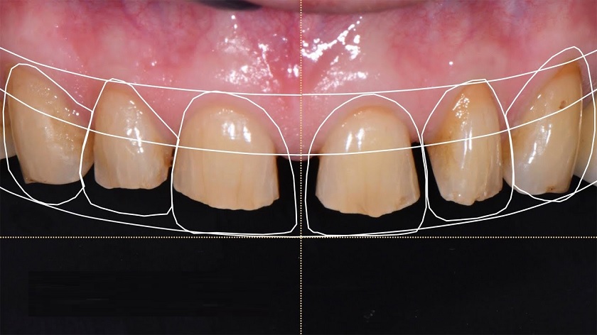Nướu răng có ảnh hưởng đến độ dài và thẩm mỹ của hàm răng