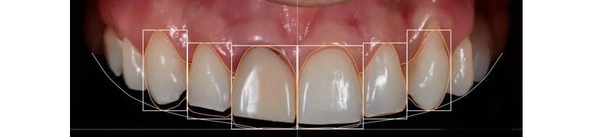 Đường cười là yếu tố quan trọng nhất trong thiết kế nụ cười