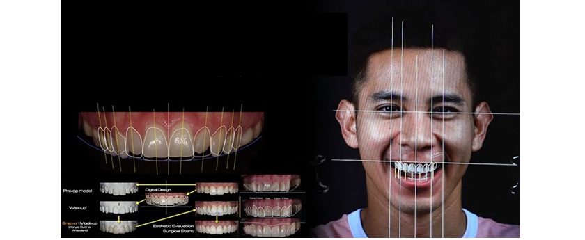 Công nghệ Thiết kế nụ cười - Bước tiến vượt bậc trong nha khoa