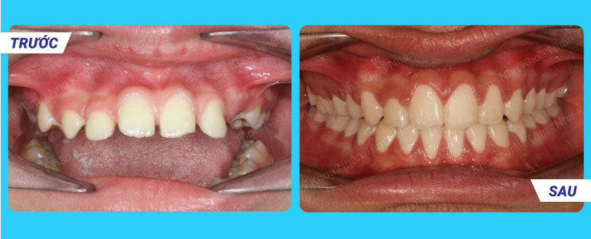 Kết quả trước - sau khi thiết kế nụ cười