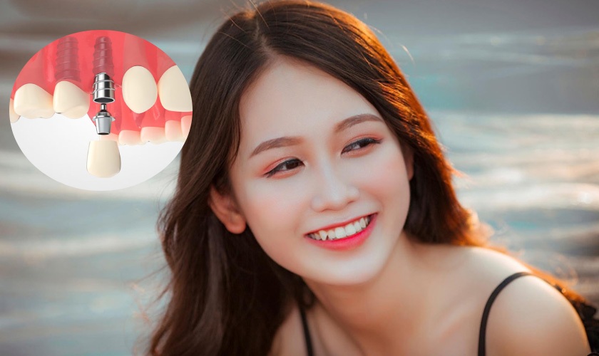 Cấy ghép Implant là phương pháp trồng răng nanh được nhiều người lựa chọn khi mất răng