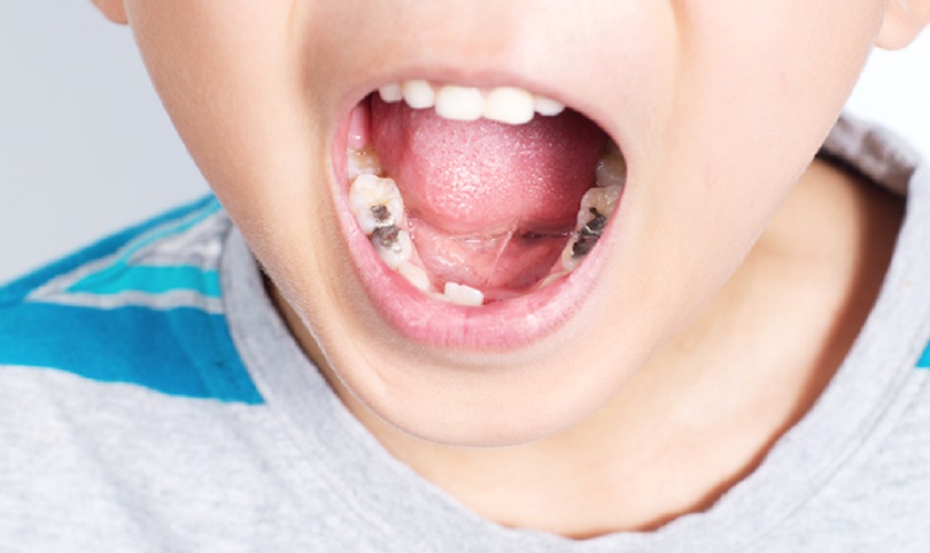 Vệ sinh răng miệng cho trẻ 