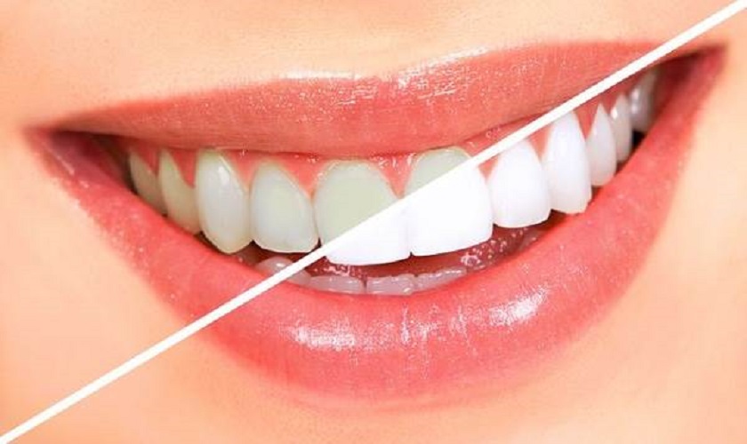 Cách tẩy trắng răng hiệu quả thuốc tẩy trắng răng của mỹ nhanh tại nhà
