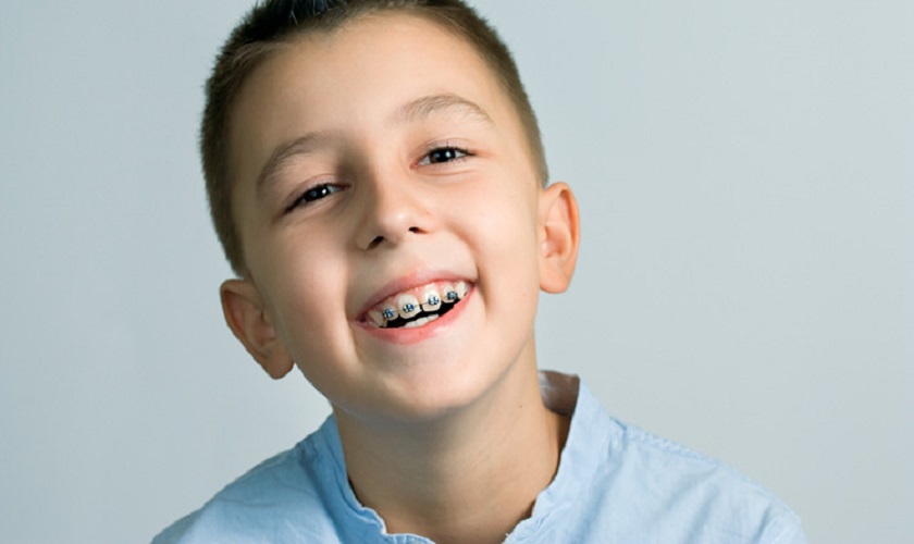 Niềng răng là gì?