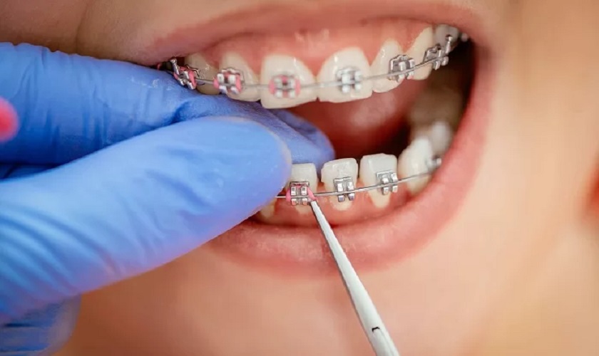 12 – 16 tuổi được xem là độ tuổi “vàng” để niềng răng