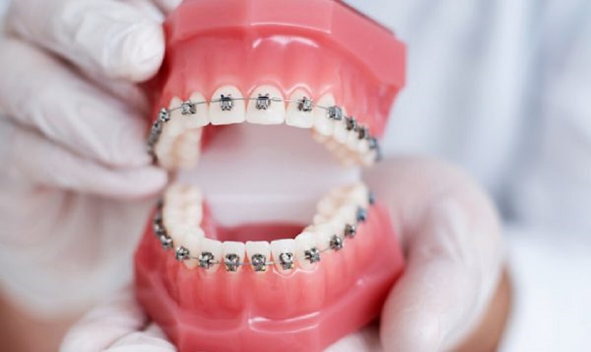 Bạn đã biết gì về phương pháp niềng răng  Nha Khoa Đại Việt