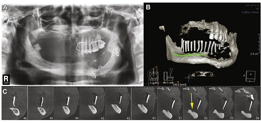 Image 2: Nhan Van Vo DDS - A Case Report With a 7-Year Follow-Up