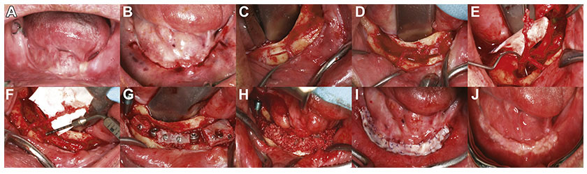 Image 3: Nhan Van Vo DDS - A Case Report With a 7-Year Follow-Up
