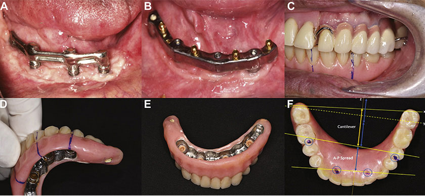 Image 4: Nhan Van Vo DDS - A Case Report With a 7-Year Follow-Up