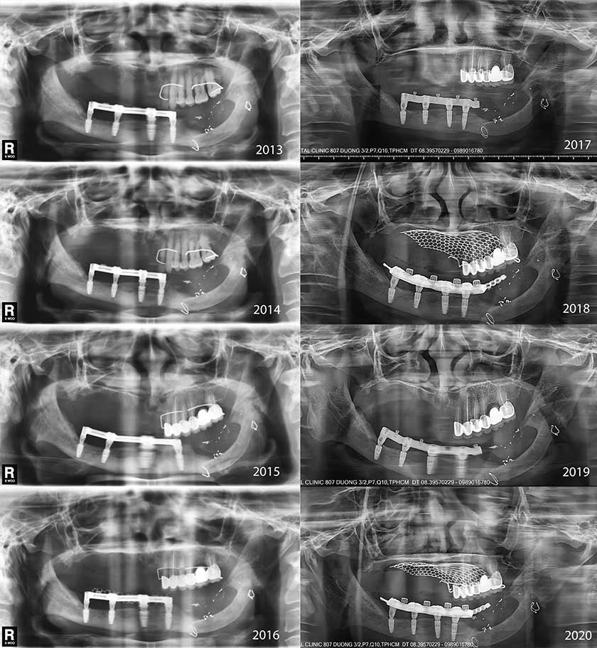 Image 5: Nhan Van Vo DDS - A Case Report With a 7-Year Follow-Up