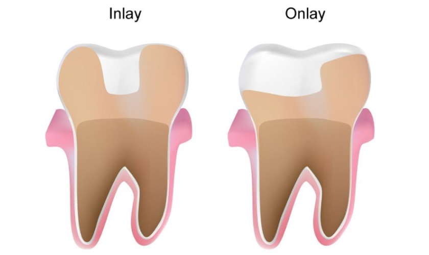 Kỹ thuật trám răng Inlay/Onlay