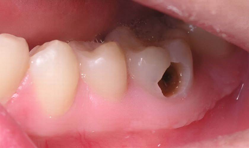 Sâu răng là nguyên nhân phổ biến gây đau răng