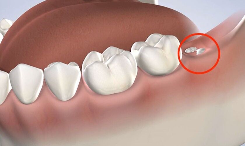 Mọc răng khôn khiến ăn uống trở nên bất tiện