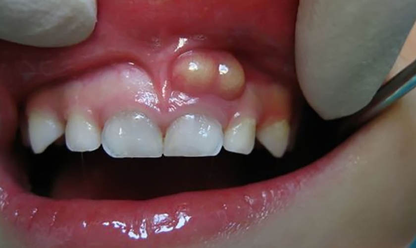 Áp xe răng thường do sâu răng gây nên