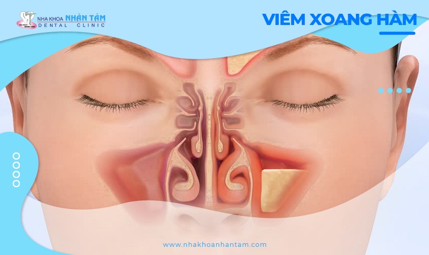 Viêm xoang hàm: Nguyên nhân, triệu chứng và cách điều trị