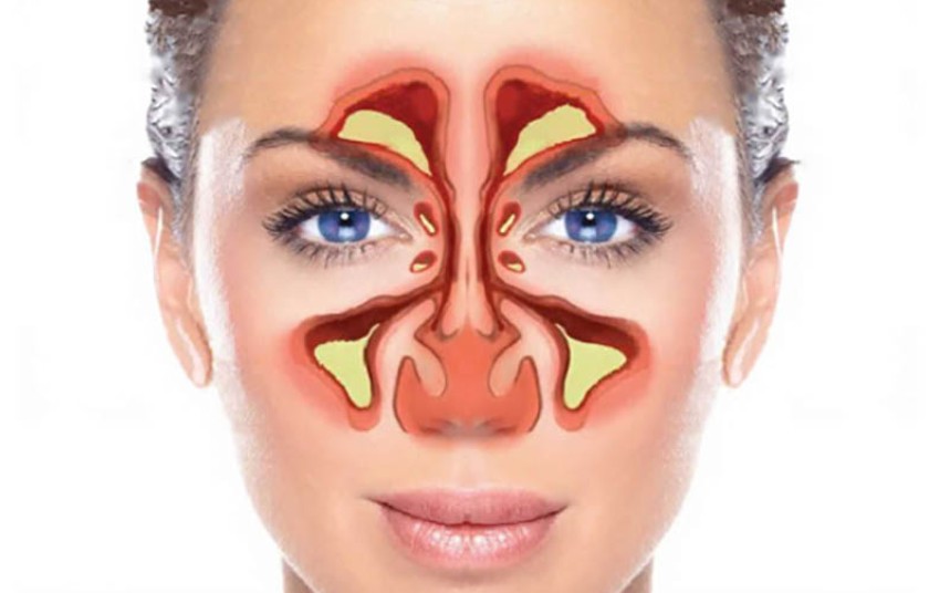 Điều trị viêm xoang hàm cần được thực hiện tại cơ sở chuyên khoa