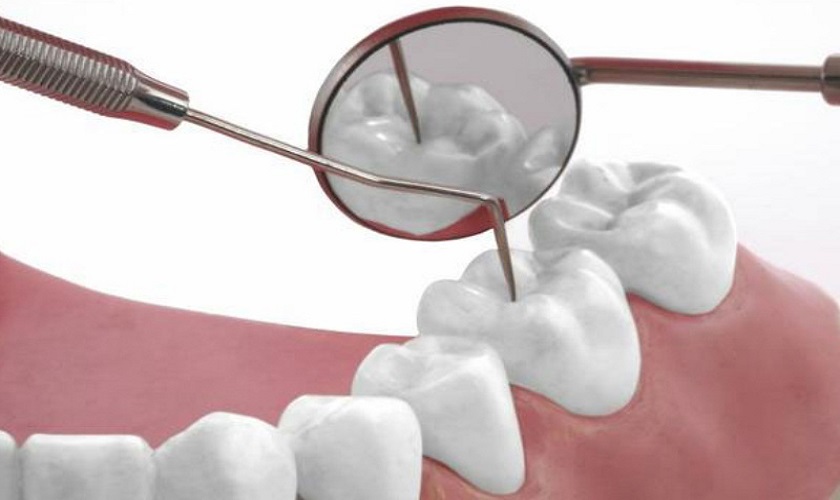 Chất liệu trám có màu sắc tương đồng với răng thật giúp đảm bảo tính thẩm mỹ