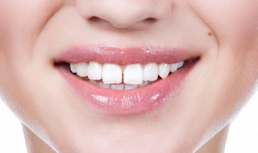 Trám răng cửa thưa – cải thiện thẩm mỹ đơn giản, hiệu quả