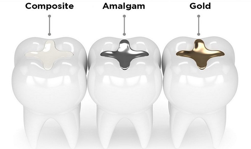 Mỗi vật liệu trám sẽ có độ bền chắc khác nhau