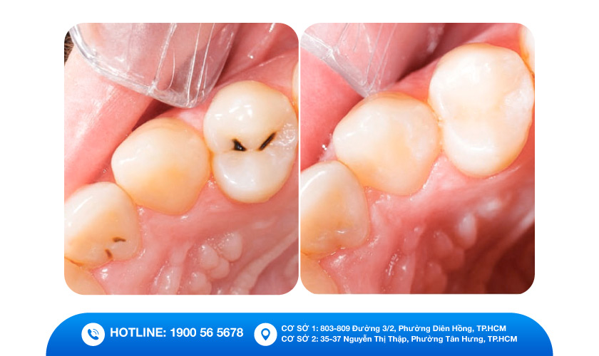 Tìm hiểu kỹ thuật và các trường hợp cần trám răng hàm dưới