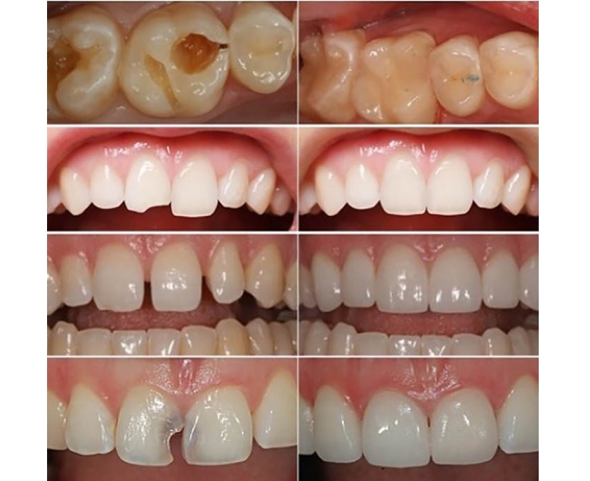 Những trường hợp cần trám răng thẩm mỹ