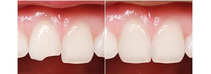 Trám răng thẩm mỹ mang đến 1 hàm răng khoẻ đẹp như mong muốn