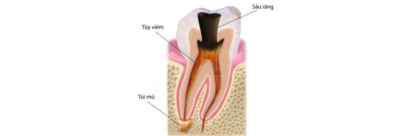 Răng bị viêm tuỷ Răng bị viêm tuỷ
