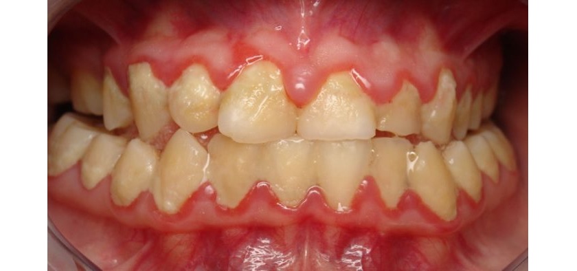 Răng bị viêm nha chu Răng bị viêm nha chu