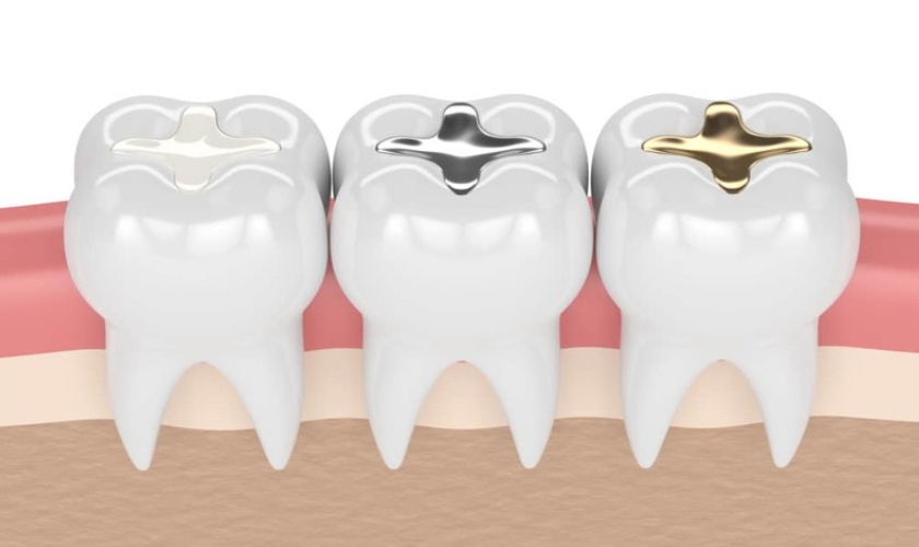 Vật liệu trám kém chất lượng khiến chỗ trám răng bị ê buốt