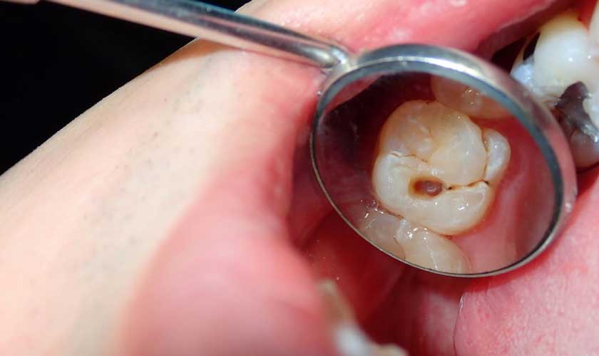 Sâu răng gây tình trạng đau nhức, hôi miệng và những biến chứng khác Sâu răng gây tình trạng đau nhức, hôi miệng và những biến chứng khác