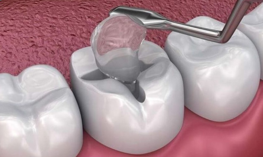 Trám răng mang lại nhiều lợi ích