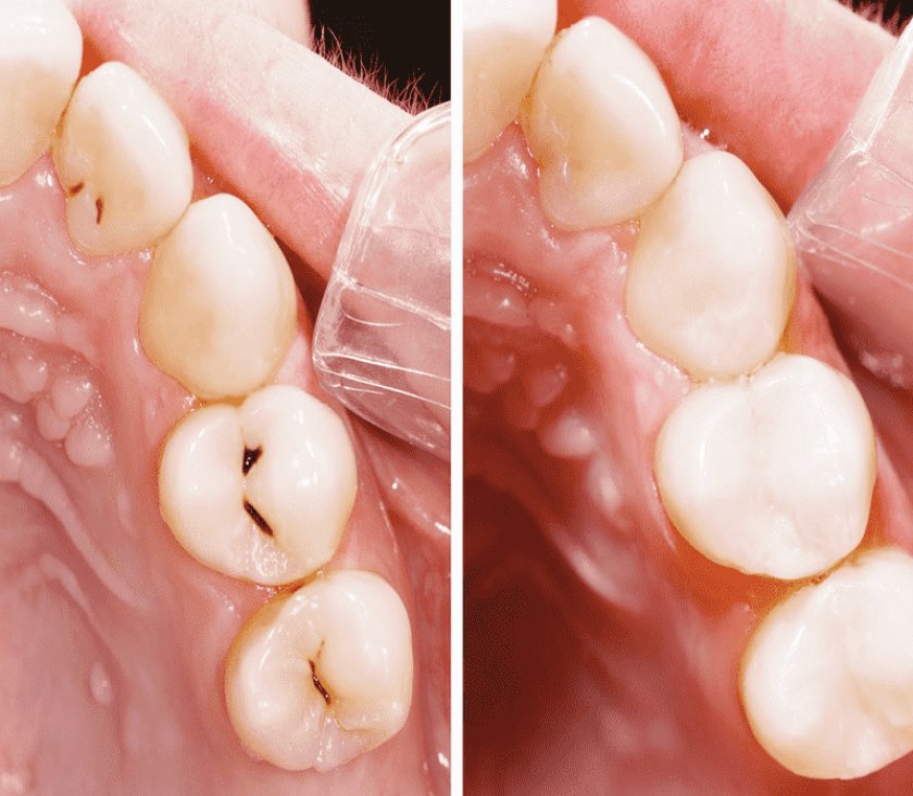 Trám răng giúp khôi phục thẩm mỹ và chức năng răng