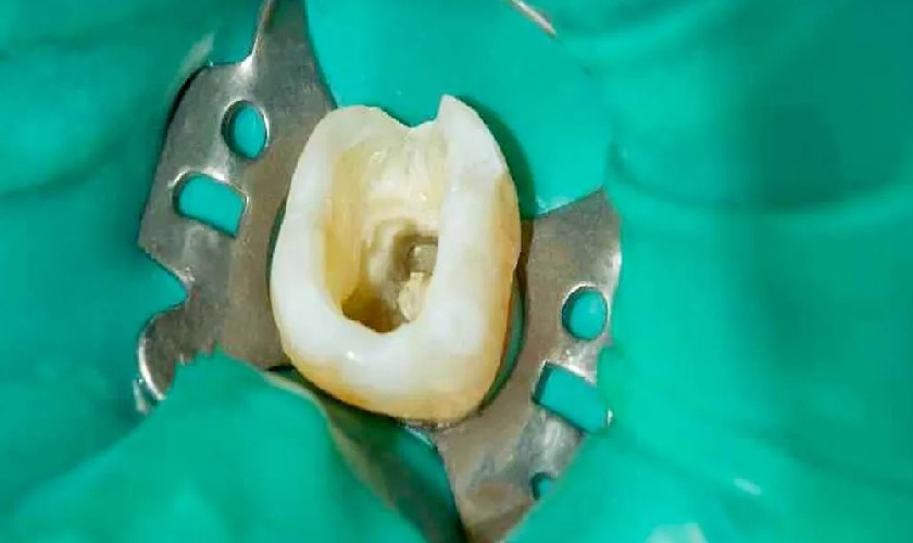 Lấy tủy răng trước khi trám răng