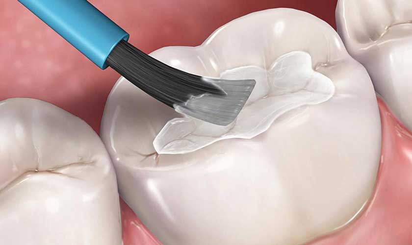 Cần tuân thủ hướng dẫn của Bác sĩ sau khi trám răng